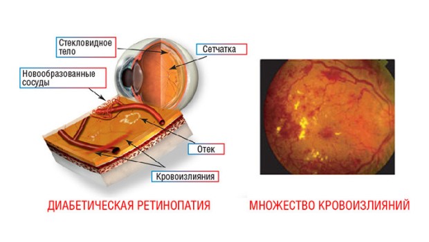 Диабетическая ретинопатия в клинике ЛЕНАР